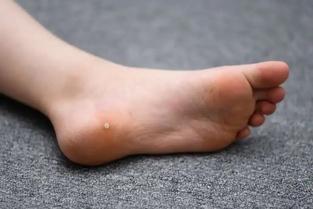 Image of verruca on the bottom of the foot that able to be treated with Cryotherapy Walton-on-Thames
