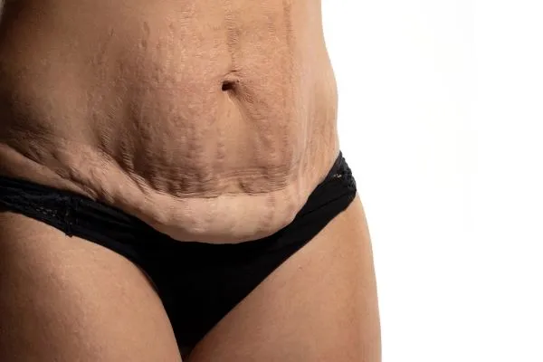 The science behind skin tightening Walton-on-Thames picture of a woman's sagging skin on the stomach
